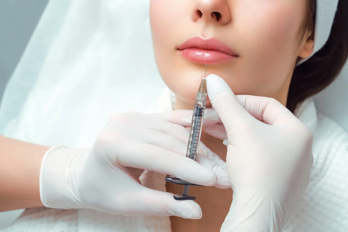 Lippenunterspritzung mit Hyaluronsäure